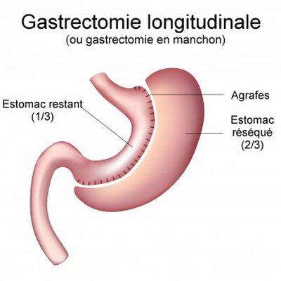 Sleeve gastrectomie Tunisie